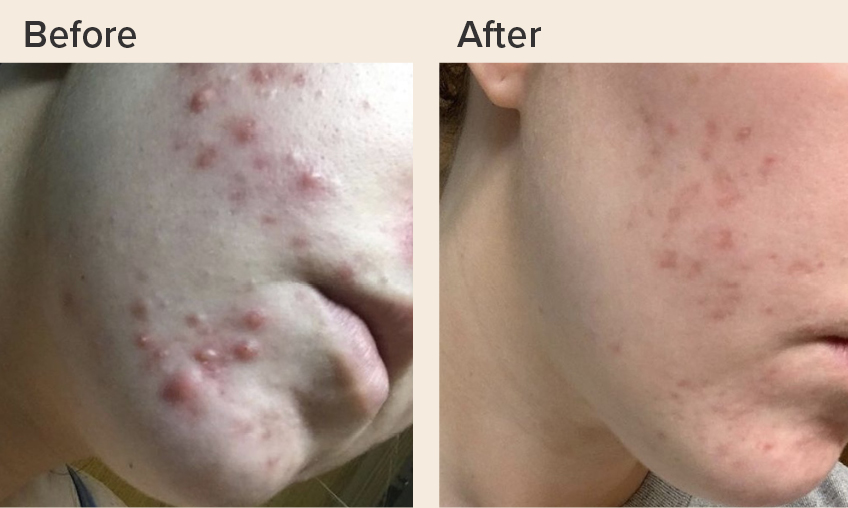 Acne-solution